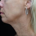 Chin & Jawline Filler Before & After Patient #24359