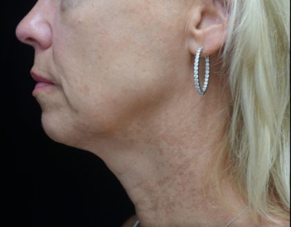 Chin & Jawline Filler Before & After Patient #24359