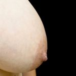Nipple Inversion Before & After Patient #24375