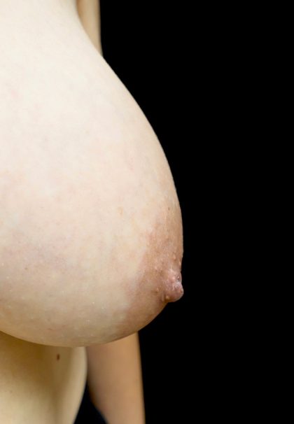 Nipple Inversion Before & After Patient #24375