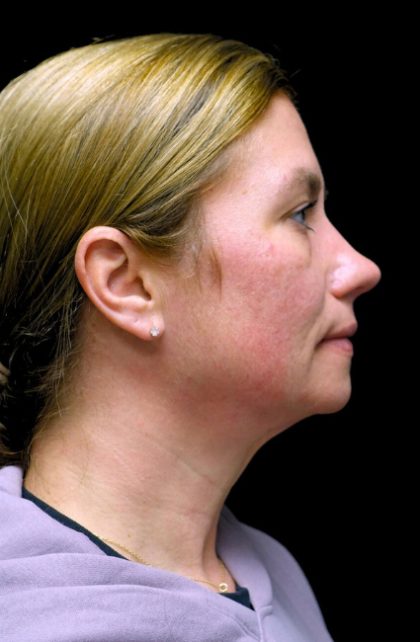Morpheus8 Before & After Patient #24352