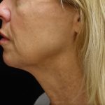 Chin & Jawline Filler Before & After Patient #24359