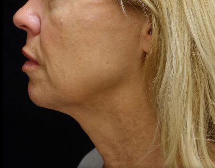 Chin & Jawline Filler Before & After Patient #24359