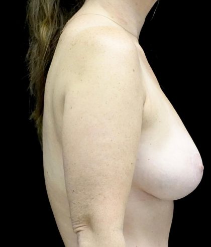 Breast Augmentation (Fat Transfer) Before & After Patient #24367