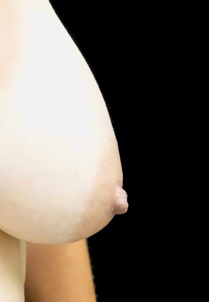 Nipple Inversion Before & After Patient #24375