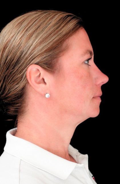 Morpheus8 Before & After Patient #24352