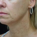 Chin & Jawline Filler Before & After Patient #24359