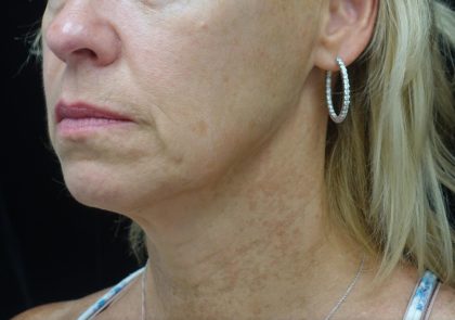 Chin & Jawline Filler Before & After Patient #24359
