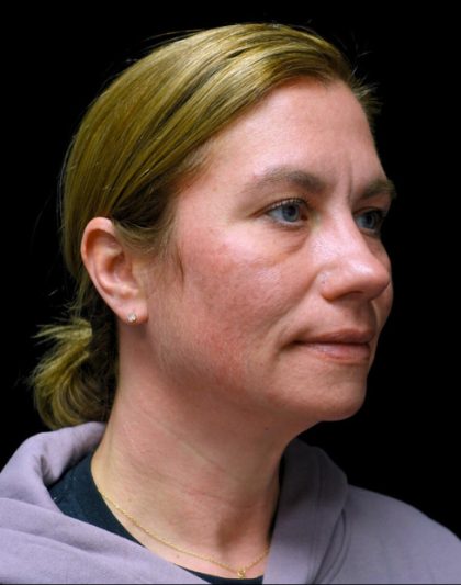 Morpheus8 Before & After Patient #24352