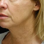 Chin & Jawline Filler Before & After Patient #24359