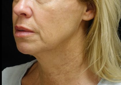 Chin & Jawline Filler Before & After Patient #24359