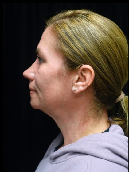 Morpheus8 Before & After Patient #24352