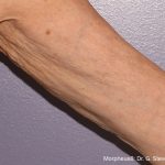 Morpheus8 Before & After Patient #24395