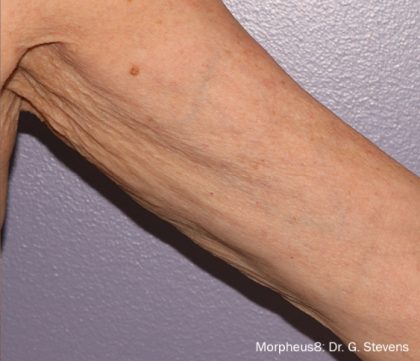 Morpheus8 Before & After Patient #24395