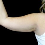 CoolSculpting Before & After Patient #24333
