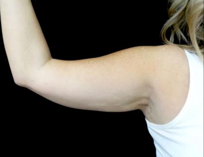 CoolSculpting Before & After Patient #24333