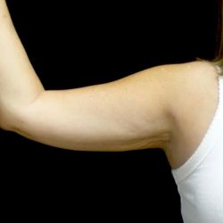 CoolSculpting Before & After Patient #24333