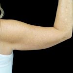 CoolSculpting Before & After Patient #24333