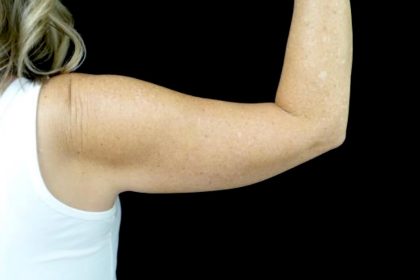 CoolSculpting Before & After Patient #24333
