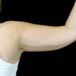 CoolSculpting Before & After Patient #24333