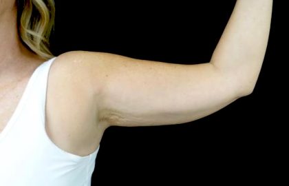 CoolSculpting Before & After Patient #24333