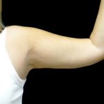 CoolSculpting Before & After Patient #24333