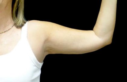 CoolSculpting Before & After Patient #24333