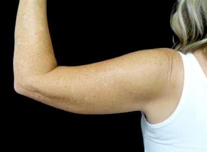 CoolSculpting Before & After Patient #24333