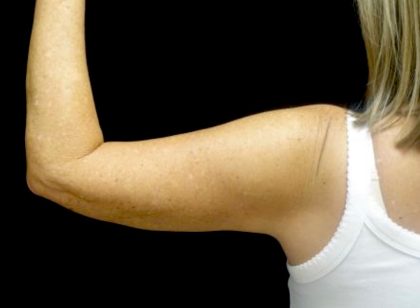 CoolSculpting Before & After Patient #24333