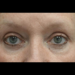 Blepharoplasty Before & After Patient #24403