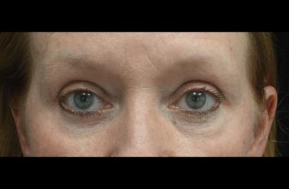 Blepharoplasty Before & After Patient #24403