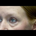 Blepharoplasty Before & After Patient #24403