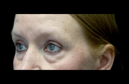 Blepharoplasty Before & After Patient #24403