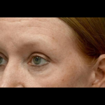 Blepharoplasty Before & After Patient #24403