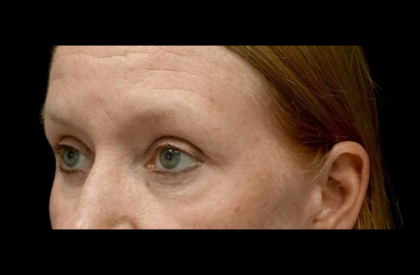Blepharoplasty Before & After Patient #24403