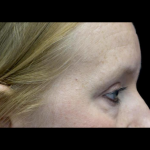 Blepharoplasty Before & After Patient #24403