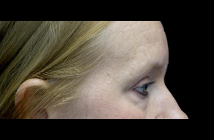 Blepharoplasty Before & After Patient #24403