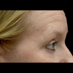 Blepharoplasty Before & After Patient #24403