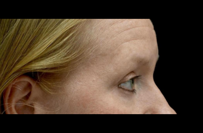 Blepharoplasty Before & After Patient #24403
