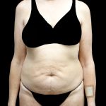 Tummy Tuck Before & After Patient #24487