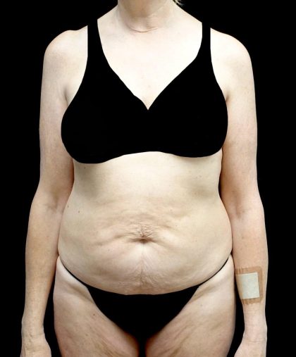 Tummy Tuck Before & After Patient #24487