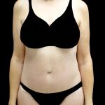 Tummy Tuck Before & After Patient #24487
