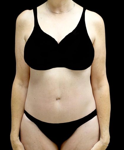 Tummy Tuck Before & After Patient #24487