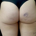 Av&eacute;li Before & After Patient #24431