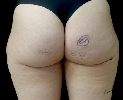 Av&eacute;li Before & After Patient #24431