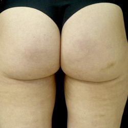 Avéli Before & After Patient #24431