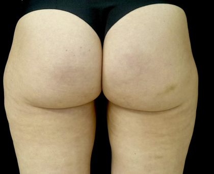 Av&eacute;li Before & After Patient #24431