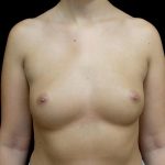 Breast Augmentation (Implants) Before & After Patient #24486