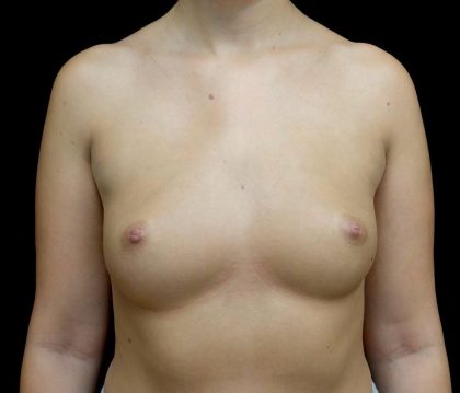 Breast Augmentation (Implants) Before & After Patient #24486
