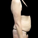 Tummy Tuck Before & After Patient #24487